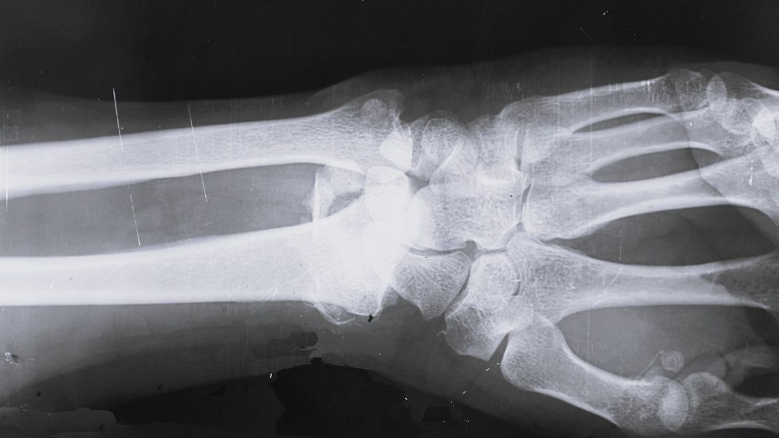 Остеоартроз: почему движение - лучшее лекарство, а уколы - не панацея