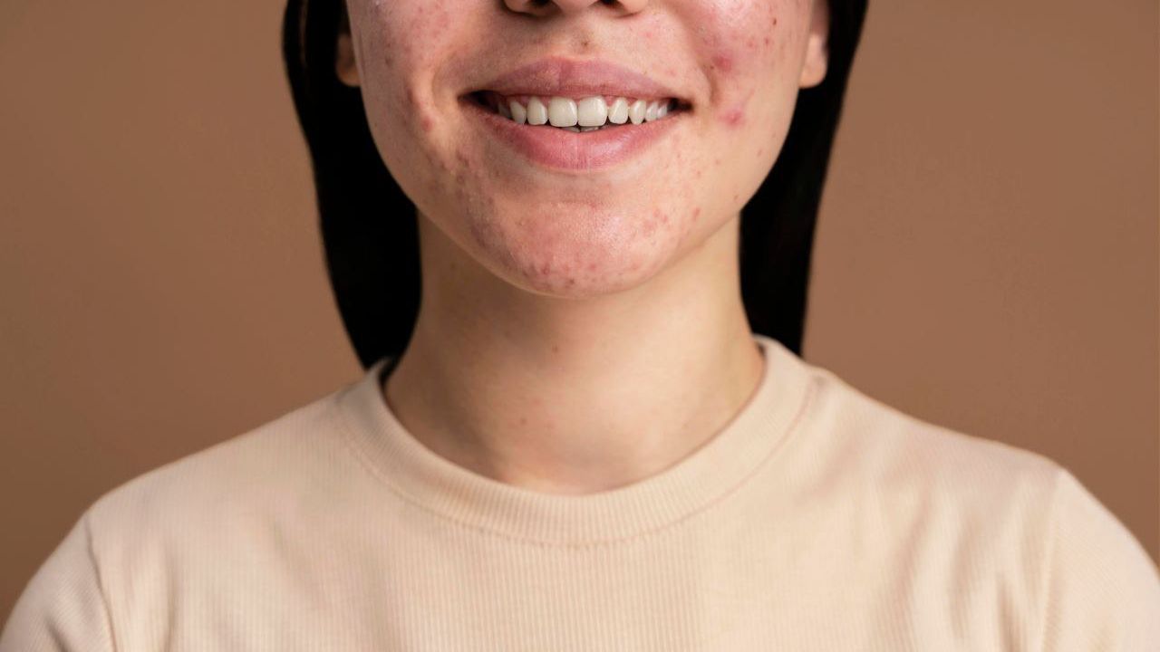 Акне взрослых: причины, симптомы и методы лечения