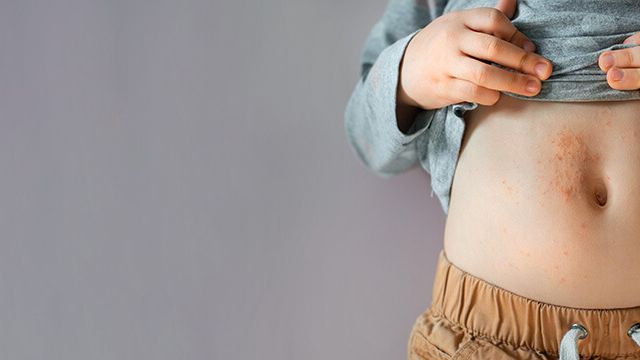 Сыпь у детей. Что делать?