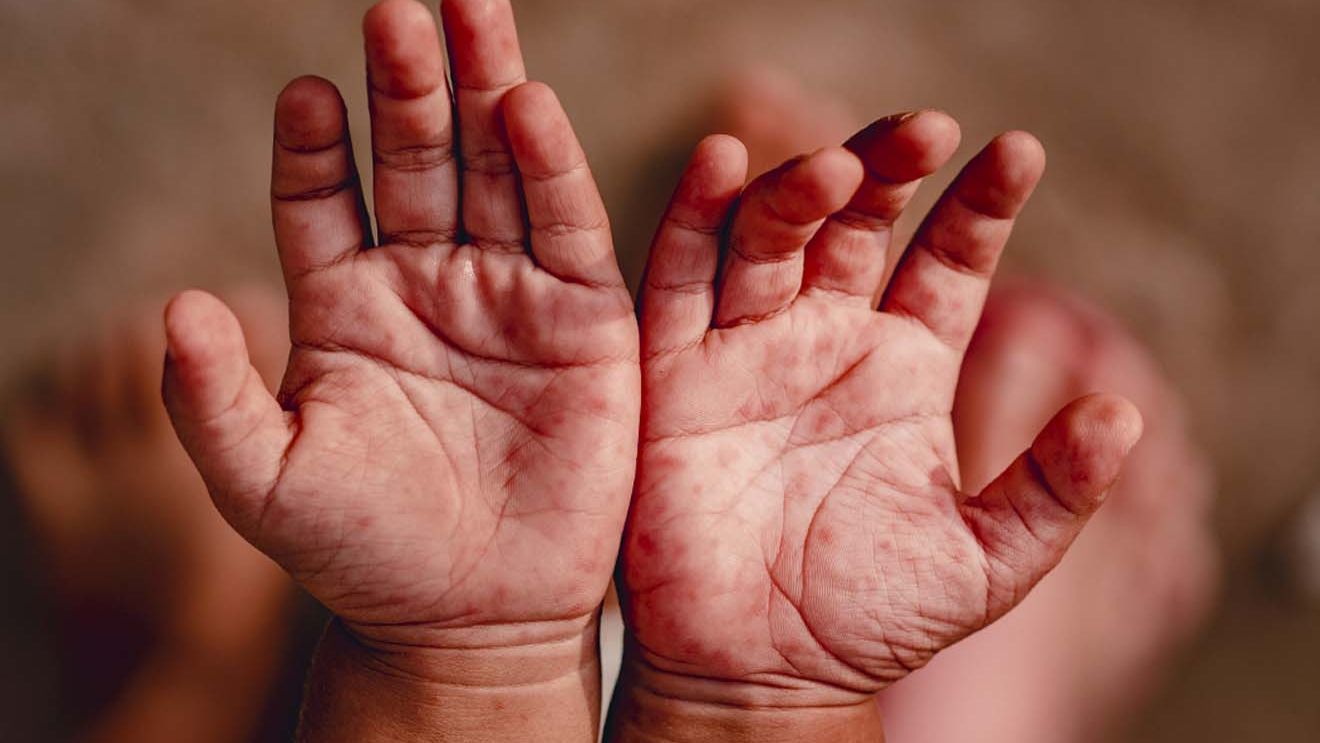 Болезнь "рука-нога-рот" . Что надо знать родителям